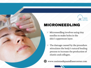 Microneedling in Dallas, Tx