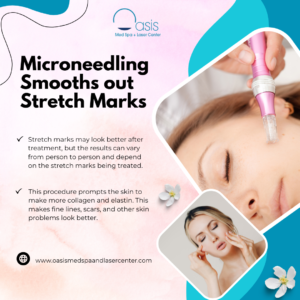 Microneedling Smooths out Stretch Marks