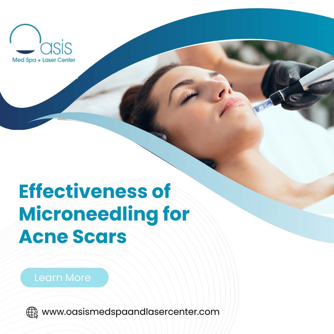 Effectiveness of Microneedling for Acne Scars