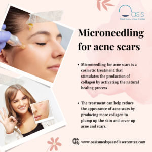 Microneedling for acne scars in Dallas, TX
