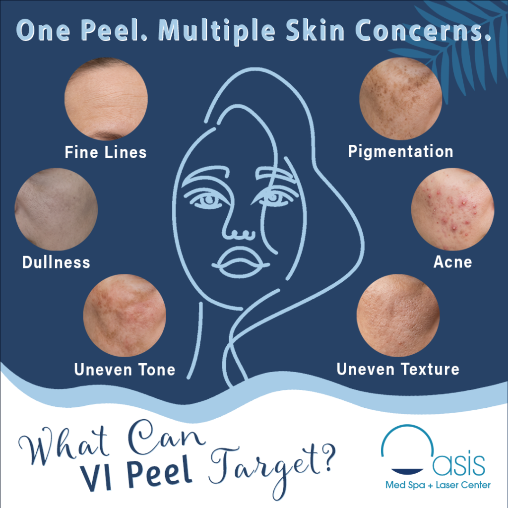 Oasis Med Spa infographic showing skin concerns targeted by VI Peel, including fine lines, acne, pigmentation, and uneven texture.